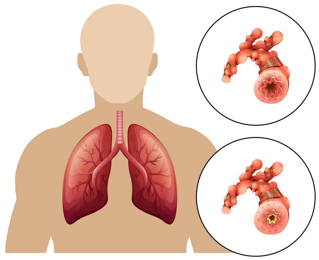 Obstructive-pulmonary-disease