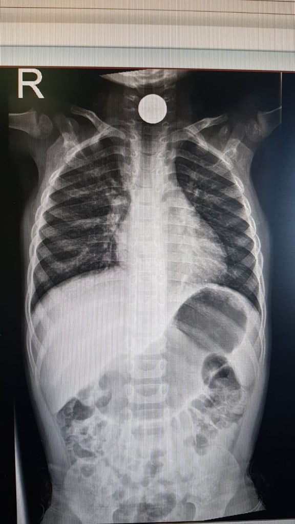 רנטגן של המטבע בבטן. צילום: מאיר