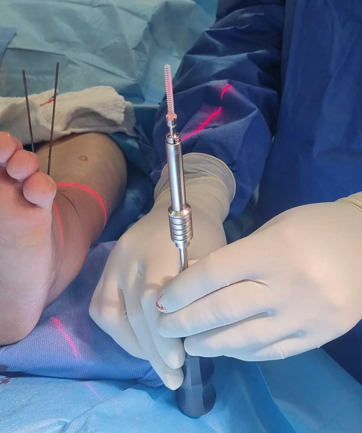 הברגים המתמוססים. צילום: זיו