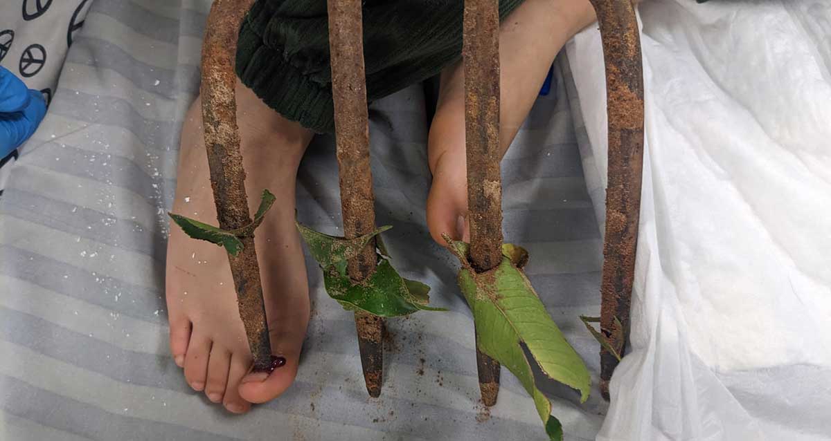 הקילשון לפני שהוצא מכף הרגל. צילום: מאיר